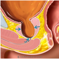 Uropatias obstrutivas