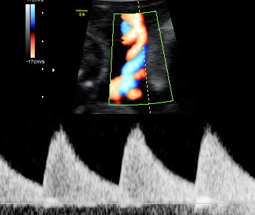 Ultrassonografia Obstétrica com Doppler