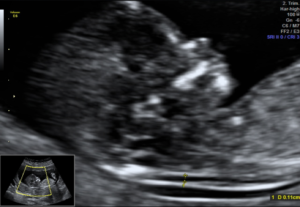 Ultrassonografia obstétrica morfológica de primeiro trimestre