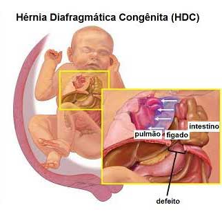Cirurgia fetal corrige hérnia diafragmática.