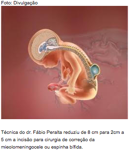 Mielomeningocele ou Espinha Bífida pode ser corrigida com cirurgia intrauterina.
