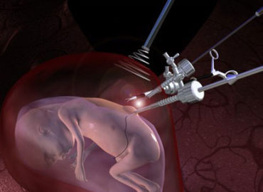 Cirurgia Fetal no Brasil