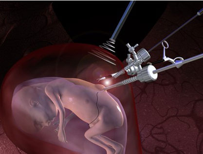 Cirurgia Fetal no Brasil