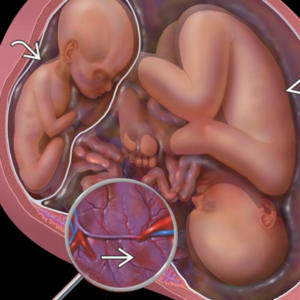 Síndrome da Transfusão Feto-Fetal