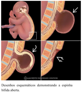 Diferentes tipos de defeito de fechamento da coluna do feto: feto em vista lateral com demonstração da coluna e fossa posterior do cérebro; ao lado direito, o esquema da falha de fechamento da coluna com herniação da meninge (meningocele); abaixo desta a raquisquise: defeito de fechamento com exposição com exposição da medula e das raízes nervosas em cobertura das meninges; ao lado esquerdo dessa além das meninges, herniação de medulas e raízes nervosas