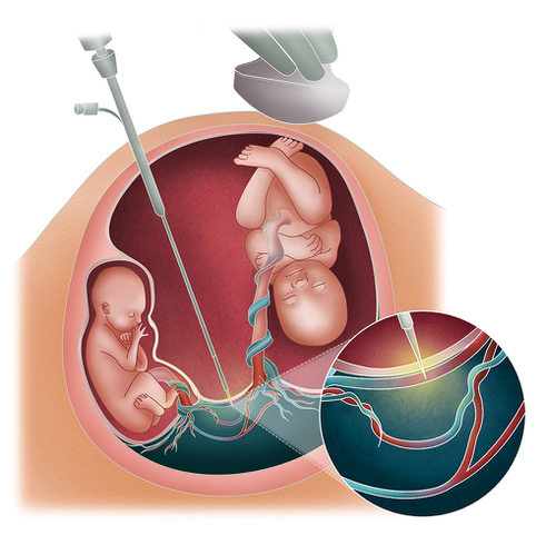 Técnica de Ablação a Laser dos Vasos Placentários por Fetoscopia utilizada no Tratamento da Síndrome da Transfusão Feto-Fetal (STFF ou STT)