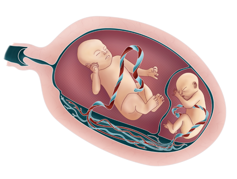 Gestação Gemelar Monocoriônica Diamniótica com fetos em condição de Síndrome da Transfusão Feto-Fetal