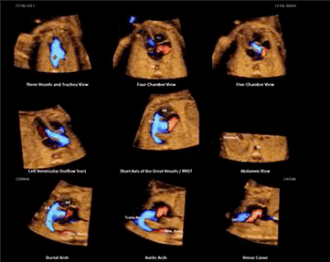 Ecodopplercardiograma na varredura em cortes tomográficos mostrando a anatomia do coração em vários planos